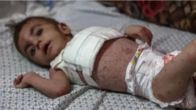كارثة صحية متفاقمة.. الأمراض تنتشر بين الأطفال في قطاع غزة