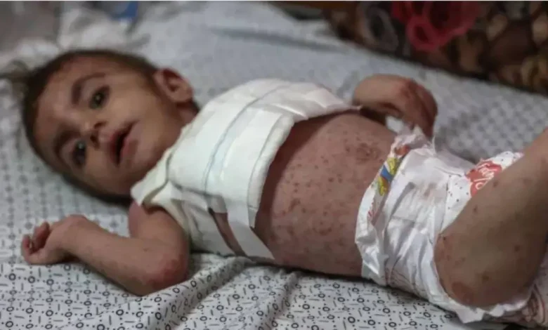 كارثة صحية متفاقمة.. الأمراض تنتشر بين الأطفال في قطاع غزة